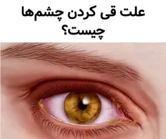 علل قی کردن چشم ها (ترشحات زرد رنگ در گوشه داخلی چشم )🤔 