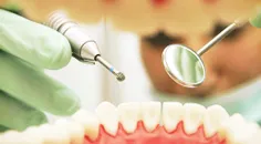 تراش دندانها قبل از گذاشتن لمینت بستگی به طرح و شکل دندان