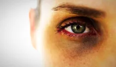 بدانید از علت های اصلی کبودی دور چشم 