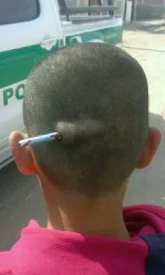 ماجرای عجیب فرو رفتن مداد در سر "امیر حسین" 