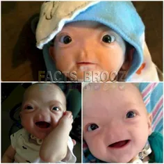 "ایلای تامسون" پسر کوچکی که بدون بینی به دنیا آمده است! ا