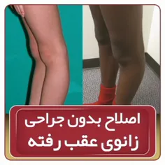 اصلاح بدون جراحی زانوی عقب رفته 