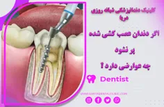 اگر دندان عصب کشی شده پر نشود چه عوارضی دارد ؟ 