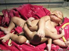 تولد#نوزاد هشت دست و پا در#هند که موجب شگفتی هندوها شده ا