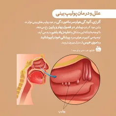 #پولیپ