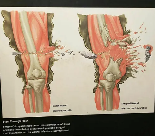 تفاوت بین زخم ترکش و زخم گلوله...!