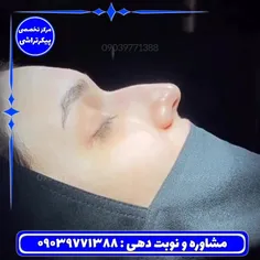 رینوپلاستی (جراحی زیبایی بینی )