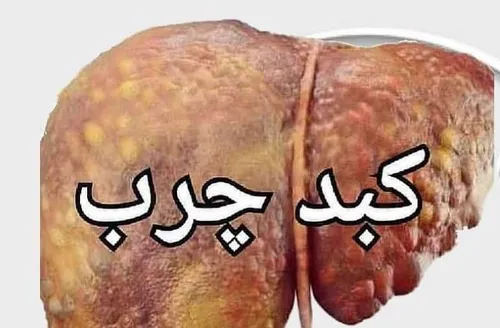 کبد چرب 💎 علائمی هشدار دهنده که به شما می گویند مبتلا به 