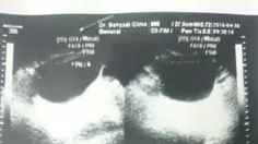 اینم سونوگرافی بالایی از مثانمه پایینی از کلیه هامه