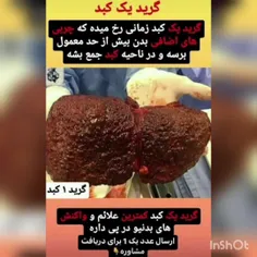 حدود 30 تا 50 درصد از ایرانی به کبد چرب مبتلا هستند. انبا