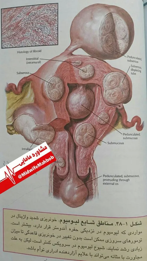 💢 تصویری از فیبروم رحمی
