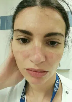 اثر کبودی‌ #ماسک و زخم روی صورت پرستاران و پزشکان  #کرونا