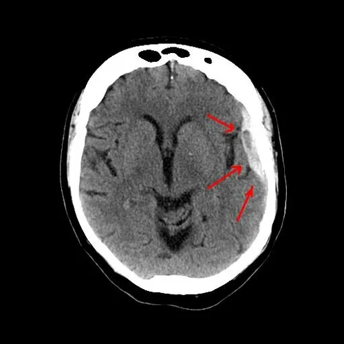 🧠خونریزی ساب آراکنوئید در بیمار با ضربه مغزی