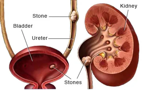سنگ کلیه یکی از بیماری های دردناک است که می تواند سبب کاه