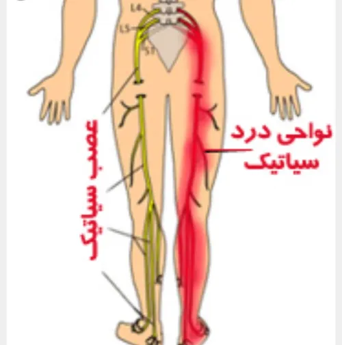 ‍ 🔴 علایم درد سیاتیک: