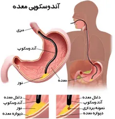 در روش آندوسکوپی، پزشک توسط لوله باریکی که از دهان وارد م