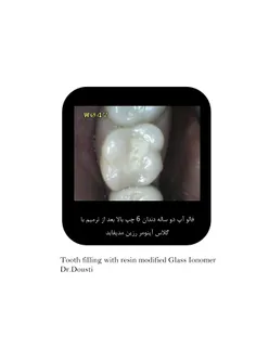ترمیم(پر کردن )دندان با گلاس آینومر توسط دکتر ابراهیم دوس