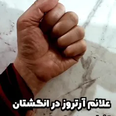 علائم آرتروز در انگشتان دست