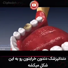 دندان پزشک دندون خرابتون رو به این شکل میکشه 