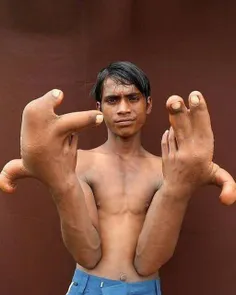 انگشتان غول پیکر یک هندی انگشتان دستان این پسر هندی به عل