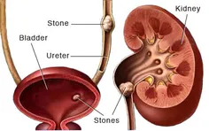 سنگ کلیه یکی از بیماری‌های دردناک است که می‌تواند سبب کاه
