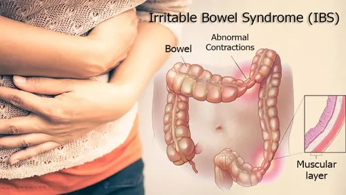 سندروم روده تحریک پذیر (IBS) چیست؟ علت و روشهای درمان