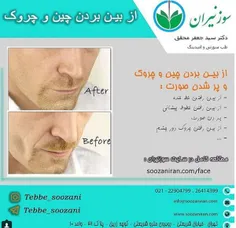 از بین رفتن خط خنده