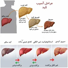 چربی در کبد طبیعی است اما اگر کبدی دارای 5 تا 10درصد چربی