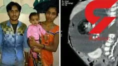 کودک 7 ماهه یک جنین زنده را در شکم خود باردار بود که با ک