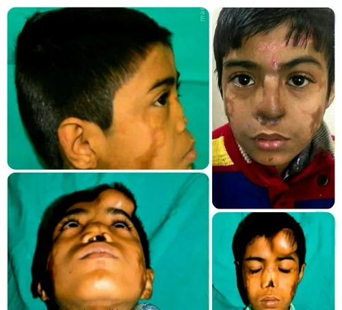 یک جراح، برای پسر ۱۲ ساله هندی یک بینی روی پیشانی او رشد 