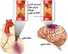 تشخیص درست حمله قلبی یا سکته بسیار مهم است