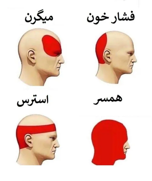 تاثیر مسائل گوناگون بر درد نواحی مختلف سر در مردان 😂