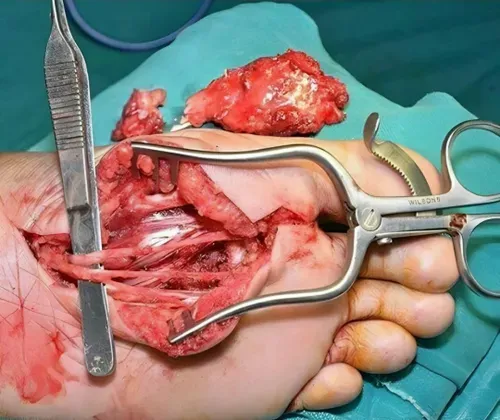 نمایی از تاندون های کف پا در جراحی