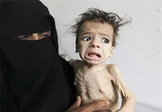 ⚠ ️ جدیدترین آمار مبتلایان به وبا در یمن؛ سوء تغذیه صدها 