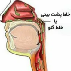 ♻️ #خلط_پشت_حلق یک شکایت شایع اما بلاتکلیف مانده در طب را