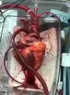 به این دستگاه، قلب درون جعبه "Heart In a Box" می گویند