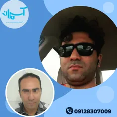 نتیجه کاشت مراجعه کننده عزیزمون بعد از گذشت 17 ماه 