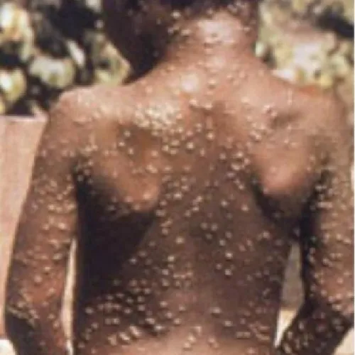 monkey pox