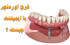 فرق اوردنچر با ایمپلنت دندان چیست ؟ 