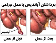 آپاندیسیت چیست؟